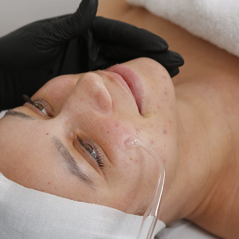 soin-acne-control-